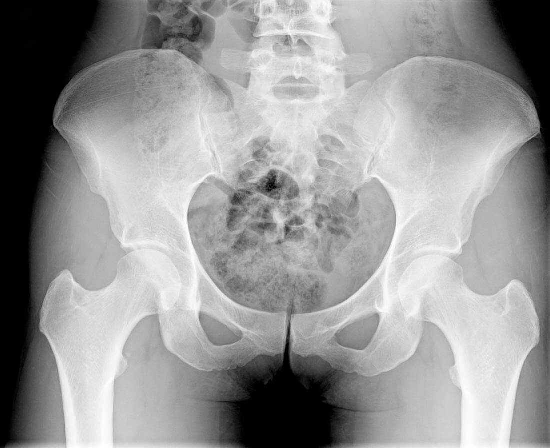Миеломная болезнь рентген костей таза